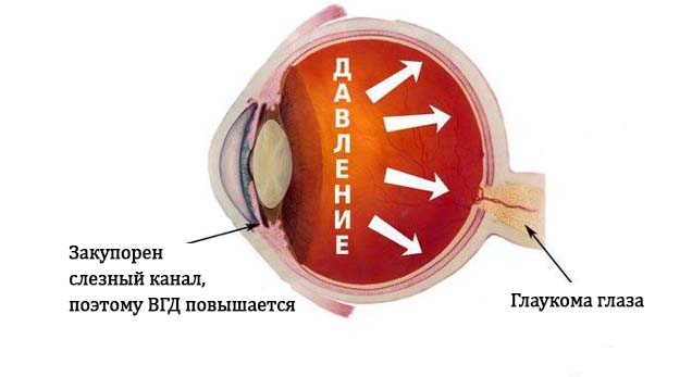 Лечение глаукомы в Санкт-Петербурге