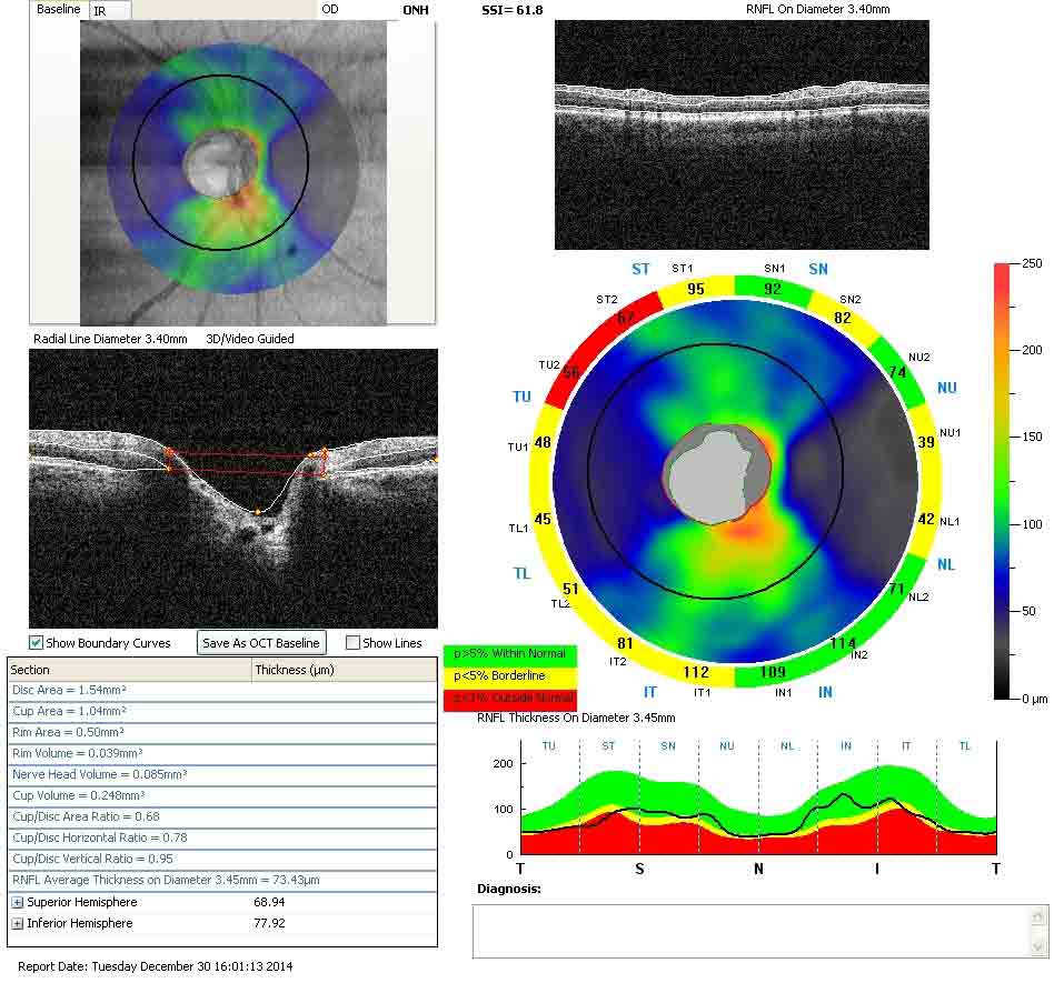 Диск зрительного нерва пациента с глаукомой